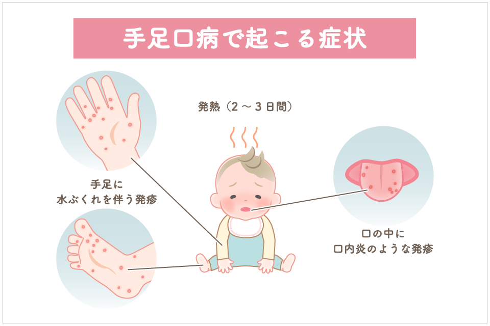 子供手足口病症状 | 手足口病 – 手足口病を知ろう!原因と予防法、治療法まで徹底解説 – PRZVRH