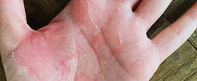 掌蹠膿疱症