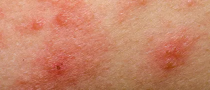 アトピー性皮膚炎