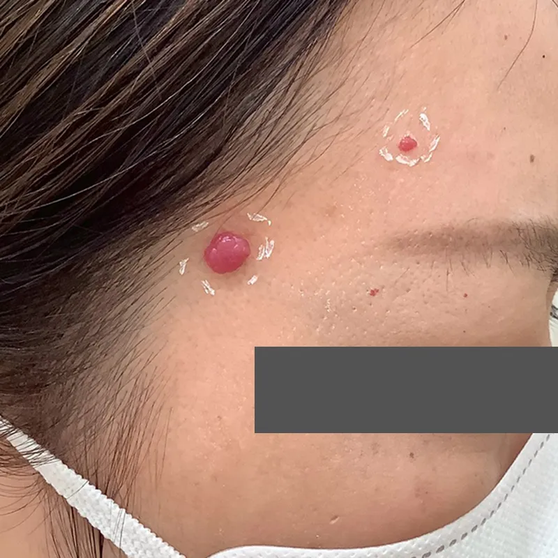 血管腫の除去の症例写真_手術前