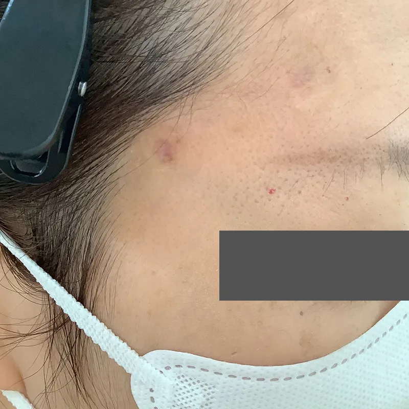 血管腫の除去の症例写真_手術後1週間