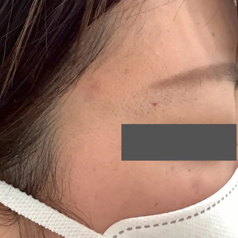 血管腫の除去の症例写真_手術後6ヶ月