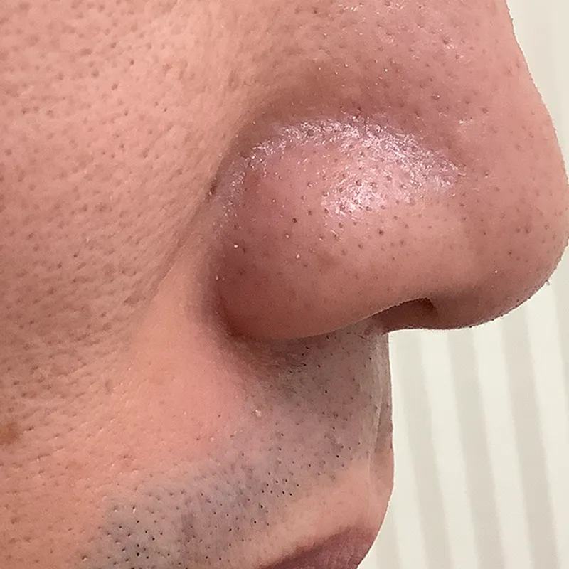 鼻横のほくろの除去手術の症例写真_手術後6ヶ月