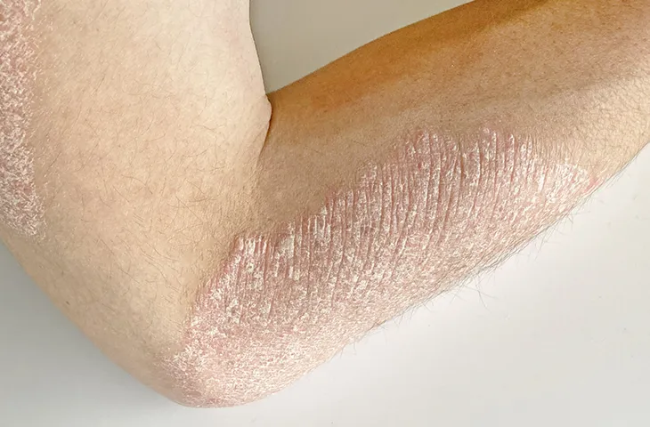 乾癬の症状の画像