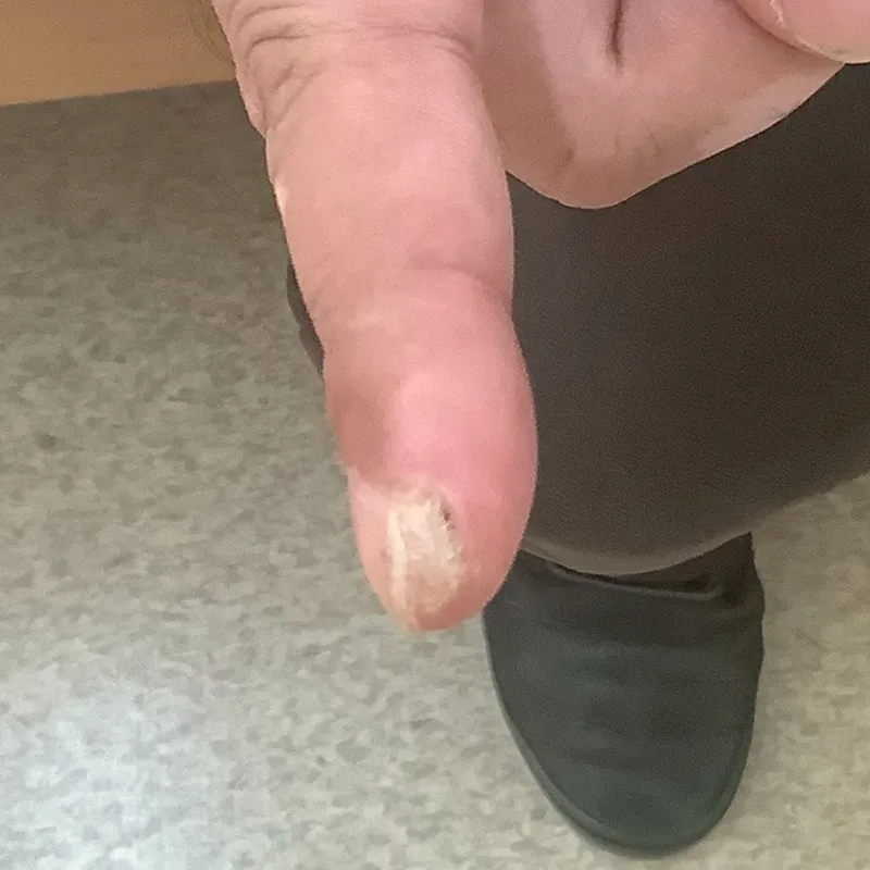 指先のウイルス性イボ（尋常性疣贅）の手術前の画像