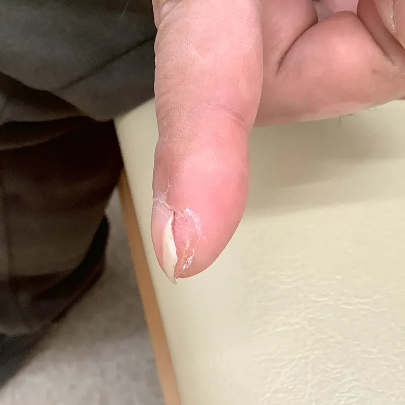 指先のウイルス性イボ（尋常性疣贅）の術後1ヶ月半の画像