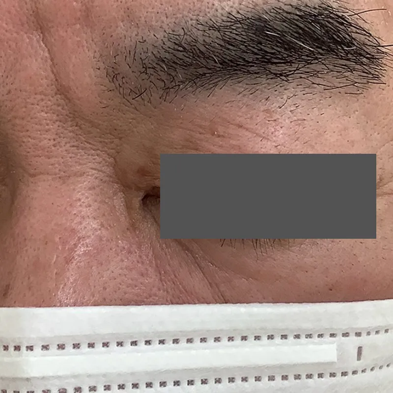 目元の粉瘤の術後2週間の画像