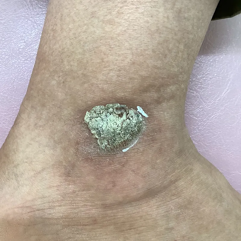 難治性のウイルス性イボ（尋常性疣贅）の手術前の画像