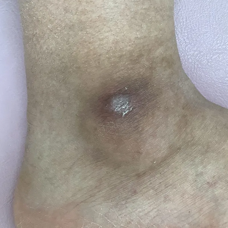 難治性のウイルス性イボ（尋常性疣贅）の術後4ヶ月の画像