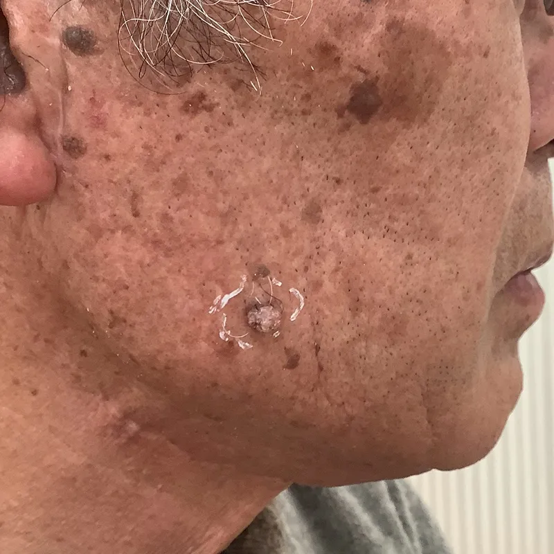 顔の脂漏性角化症の手術前の画像