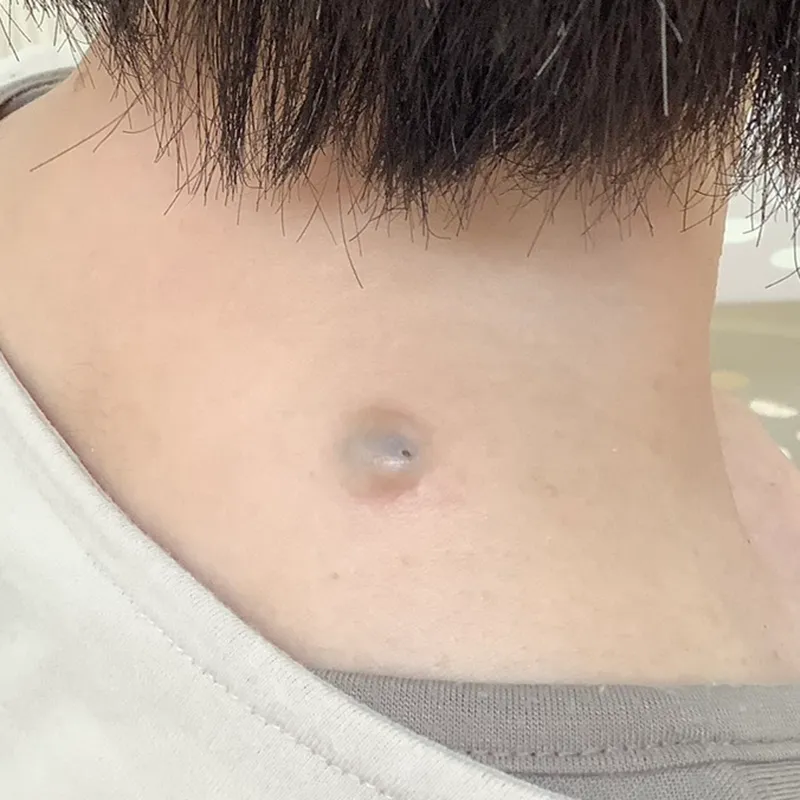 首元の粉瘤の手術前の画像
