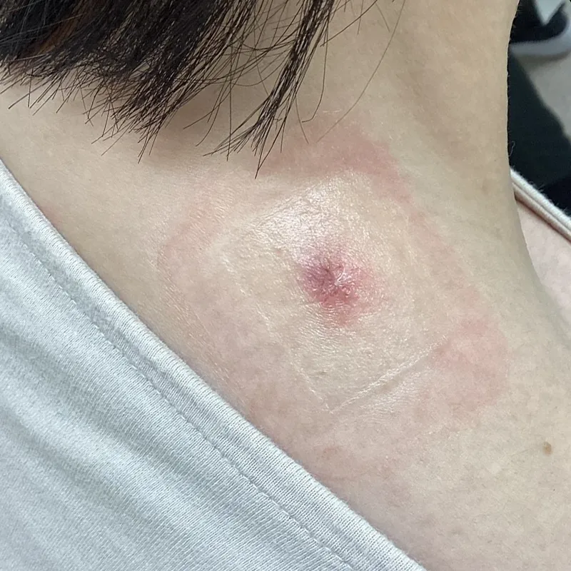 首元の粉瘤の術後1週間の画像