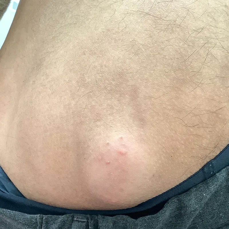 臀部の大きな粉瘤の手術前の画像