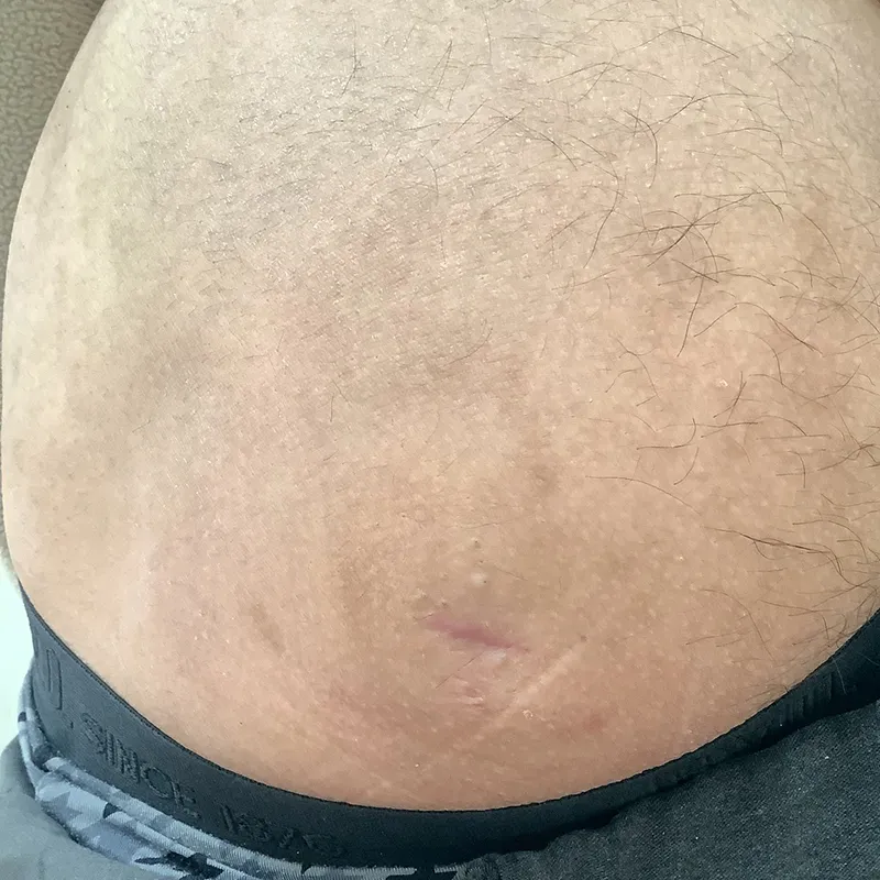 臀部の大きな粉瘤の術後3ヶ月の画像