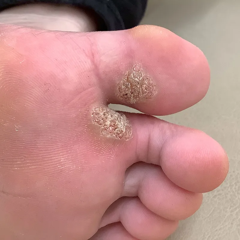 足のウイルス性イボ（尋常性疣贅）の手術前の画像