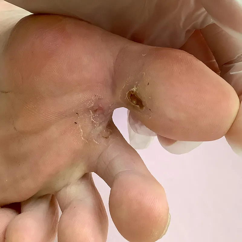 足のウイルス性イボ（尋常性疣贅）_術後1ヶ月の画像