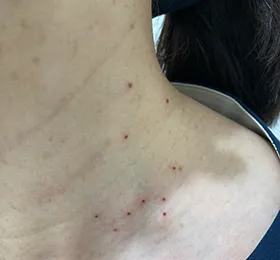 首の脂漏性角化症のプラズマペンによる症例写真_施術直後