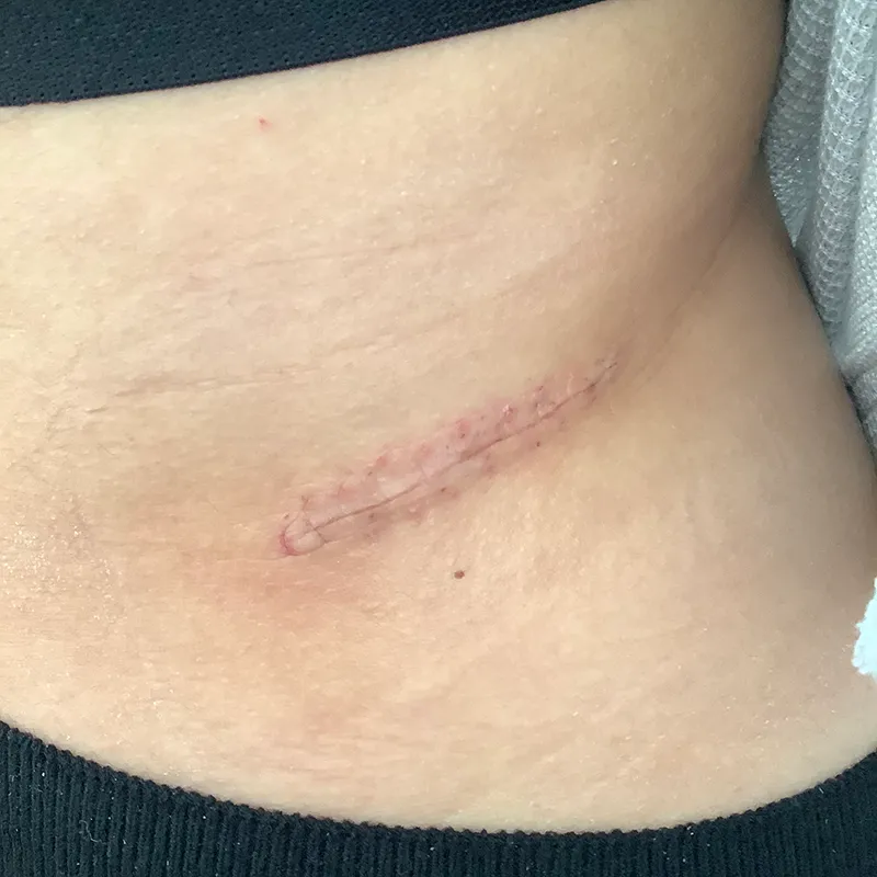 腹部の大きなほくろの術後1週間の症例写真