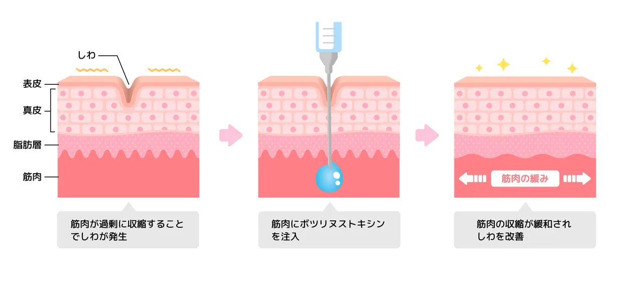 ボトックス注射によるシワ改善のメカニズム