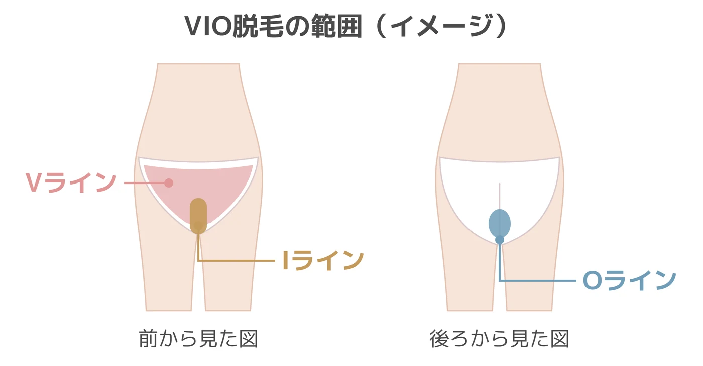 VIO脱毛の範囲の図解。前から見た図にVライン（下着からはみ出やすい部分）とIライン（性器周辺）、後ろから見た図にOライン（肛門周辺）を示す。
